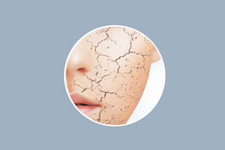dry-skin